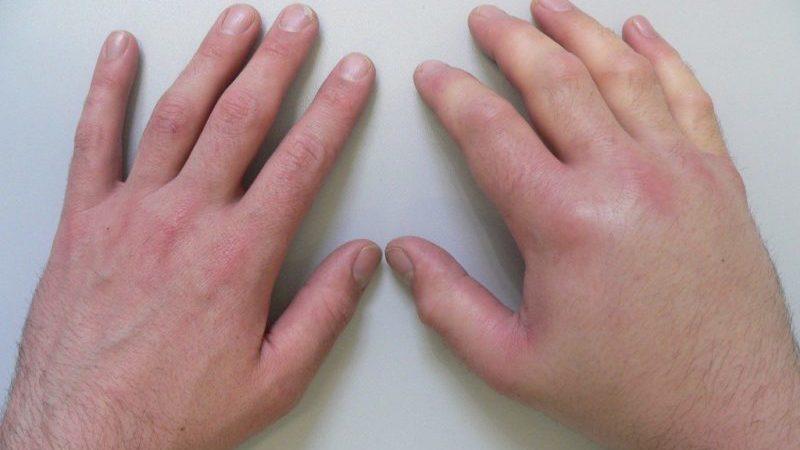 Что такое хондрома и как её лечат