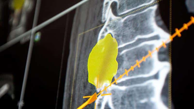 Что такое невринома позвоночника