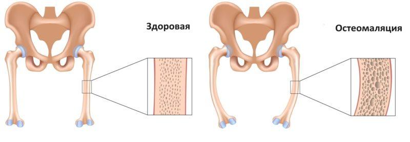 Что такое остеомаляция и как её лечить