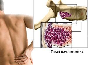 Что такое гемангиома позвоночника и как ее лечат