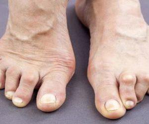 Как лечат синдром Фелти