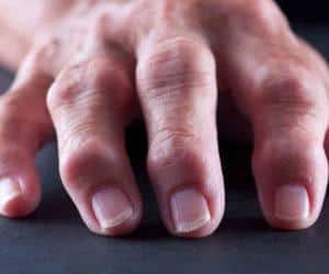 Как лечат синдром Фелти