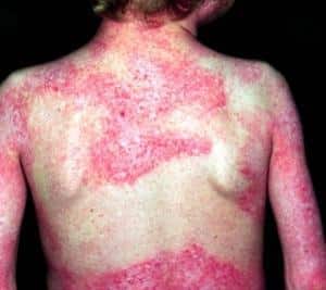 Как лечить дерматомиозит