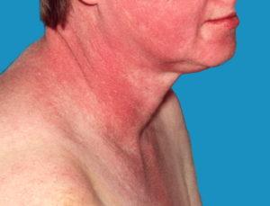 Как лечить дерматомиозит