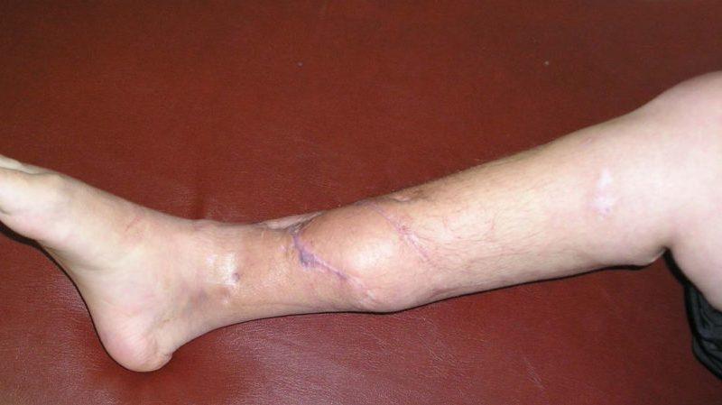 Как лечить гематогенный остеомиелит