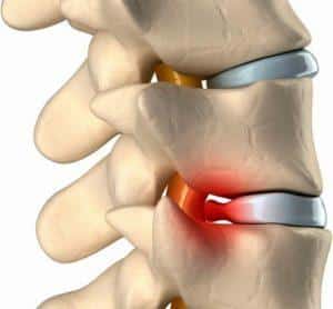 Как лечить конкресценцию позвонков