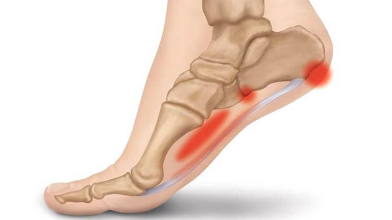 Как лечить остеофиты