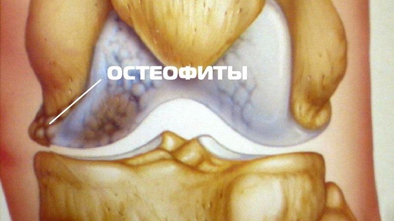 Как лечить остеофиты