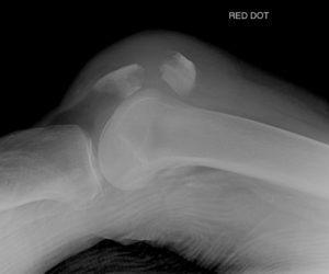 Как лечить перелом коленной чашечки