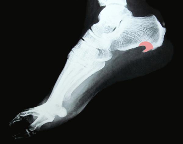 Как лечить плантарный фасциит