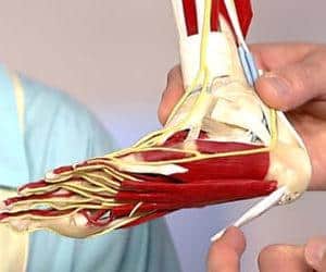 Как лечить плантарный фасциит