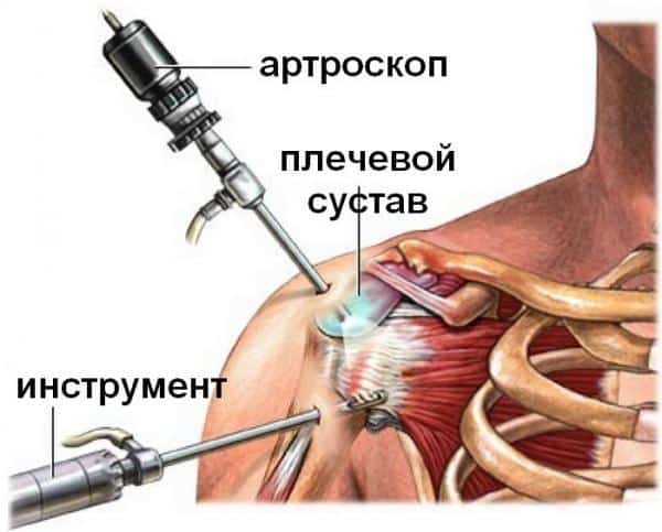 Как лечить повреждение суставной губы плечевого сустава