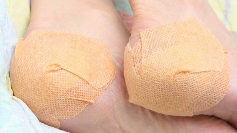 Как лечить пяточную шпору димексидом
