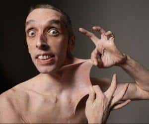 Как лечить синдром дисплазии соединительной ткани