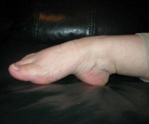 Как лечить синдром дисплазии соединительной ткани