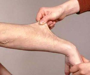 Как лечить синдром дисплазии соединительной ткани