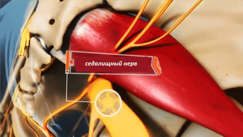 Как лечить синдром грушевидной мышцы
