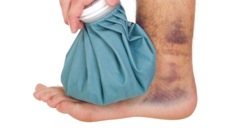 Как лечить ушиб голеностопного сустава