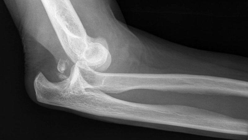 Как лечить вывих предплечья