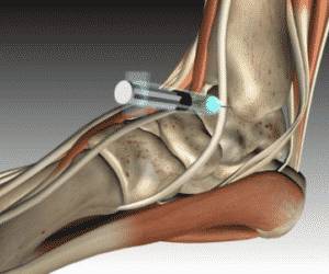 Как применять препарат Флостерон