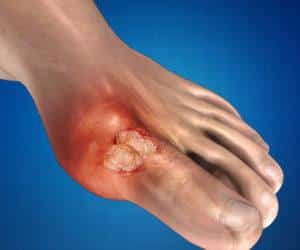 Как принимать Найз при подагре