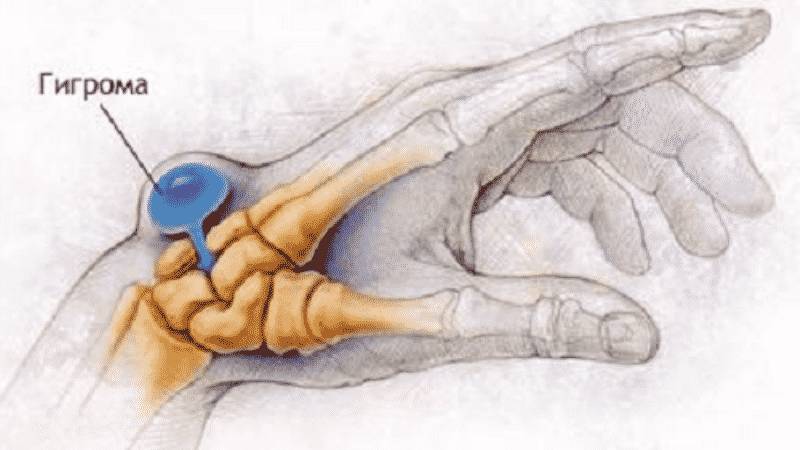 Как проходит хирургическое удаление гигромы