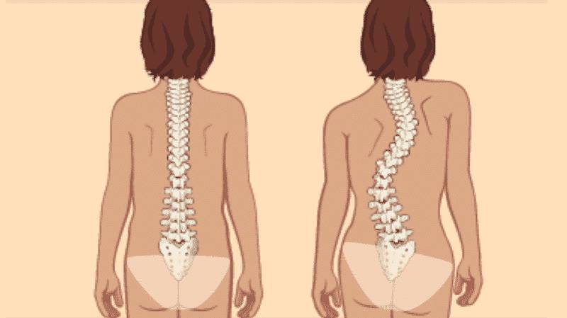 Как узнать есть ли искривление позвоночника