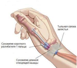 Как лечить синдром Де Кервена