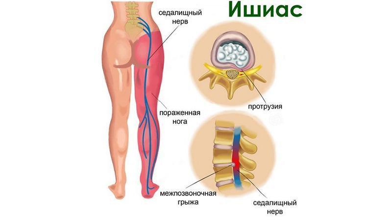 Какие обезболивающие применяют при защемлении седалищного нерва