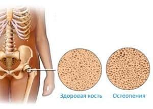 Что такое остеопения