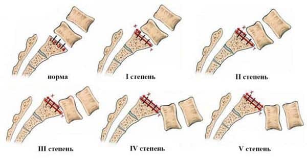 Что такое спондилолистез и как его лечить