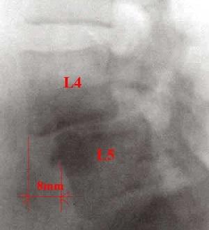 Что такое спондилолистез и как его лечить