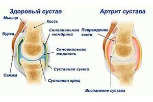 Как лечить артрит коленного сустава