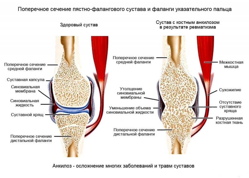Что такое анкилоз и как его лечить