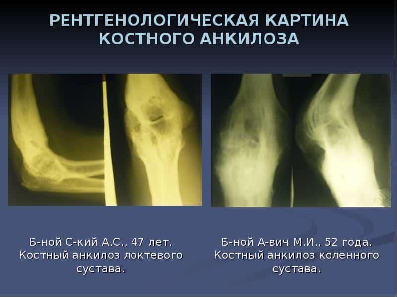 Что такое анкилоз и как его лечить
