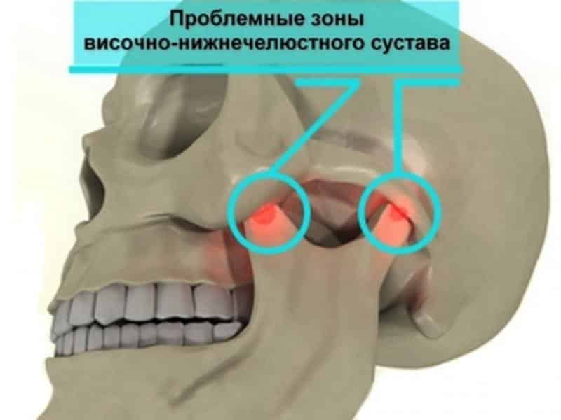 Что такое анкилоз и как его лечить