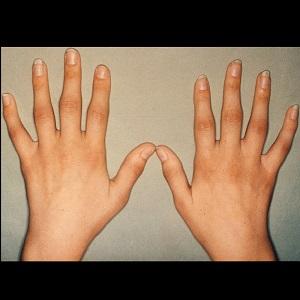 Как лечить артрит на пальцах рук