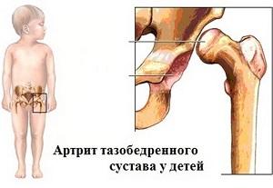 Как лечить артрит тазобедренного сустава