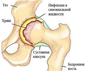 Как лечить артрит тазобедренного сустава