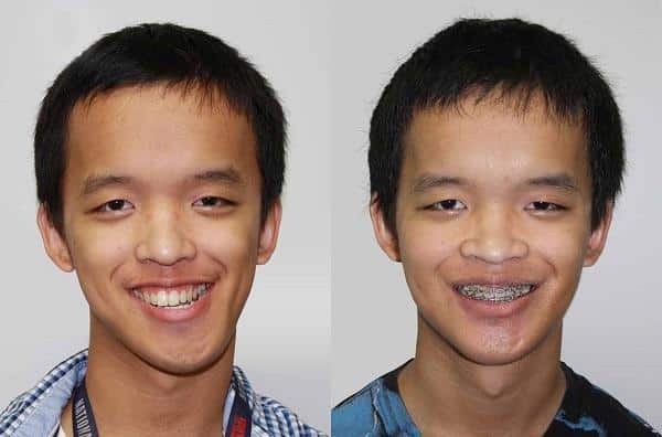 Как лечить артроз челюстного сустава