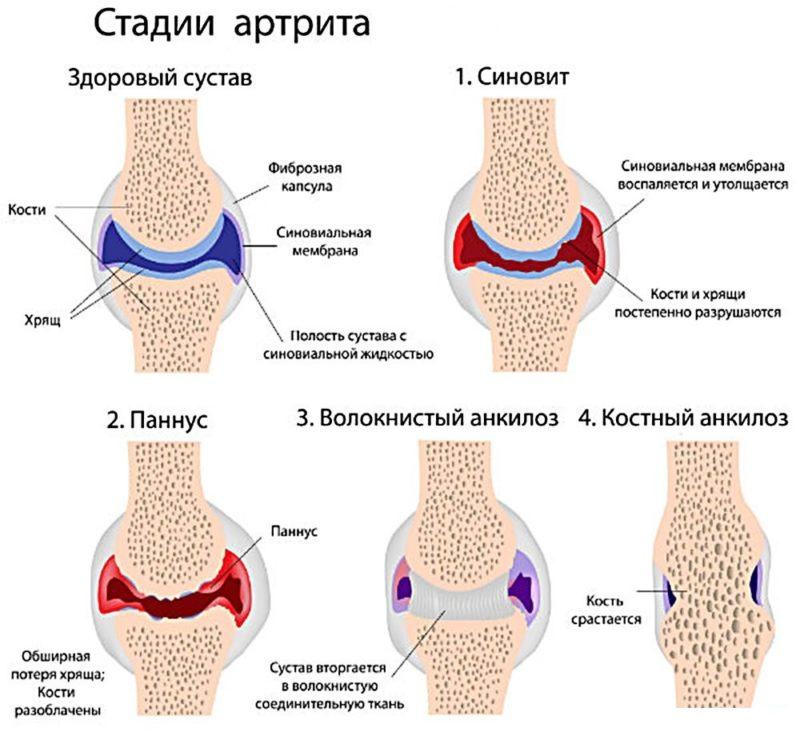 АЦЦП и другие анализы при артрите