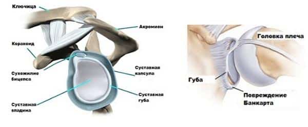 Как лечить повреждение банкарта плечевого сустава