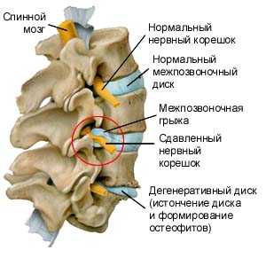 Что делать при грыже во время беременности