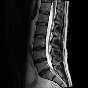 Что делать при грыже во время беременности