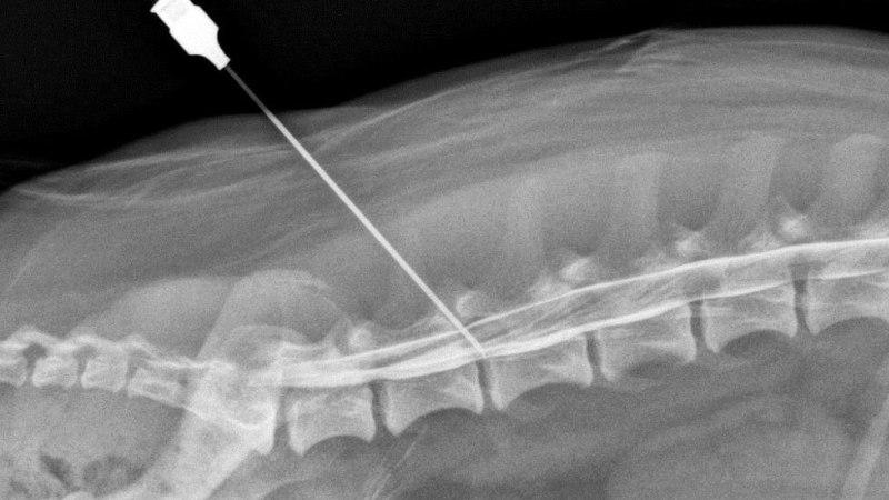 Что такое блокада позвоночника при грыже