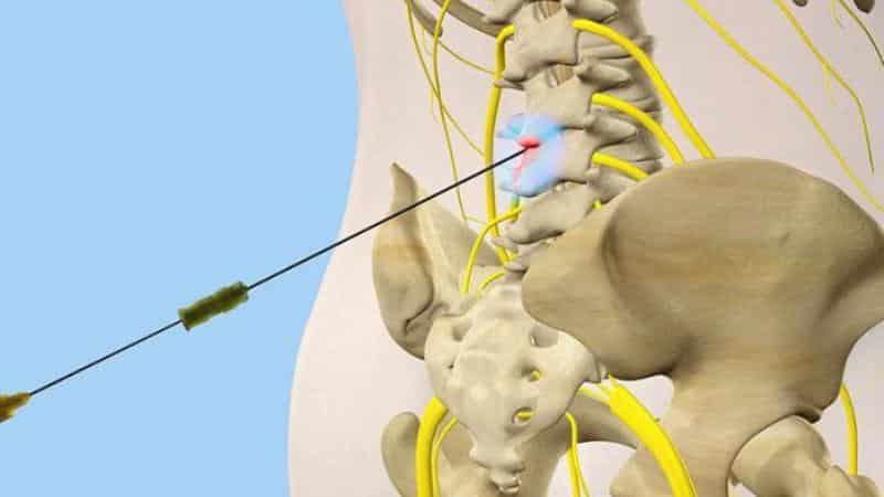 Что такое блокада позвоночника при грыже