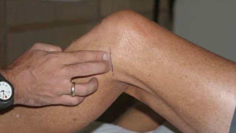 Как лечить боль в колене сбоку с внешней стороны