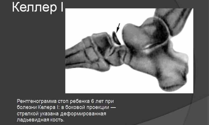 Что такое болезнь Келлера и как её лечить