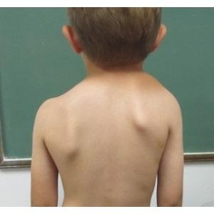 Как лечить болезнь Шпренгеля