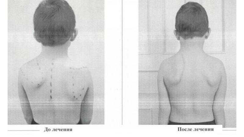 Как лечить болезнь Шпренгеля